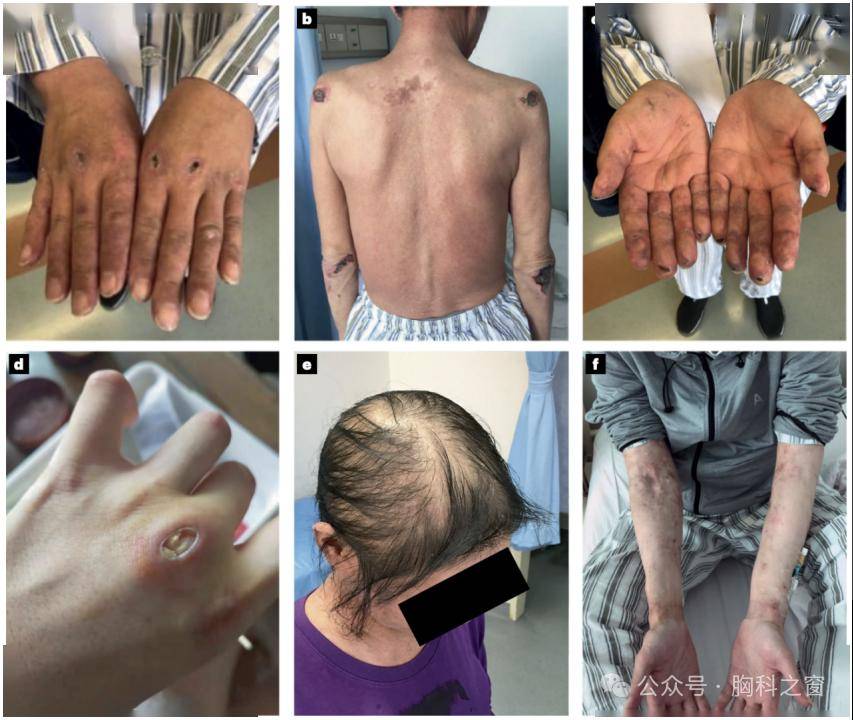 抗mda5抗体阳性皮肌炎的发病机制及临床进展