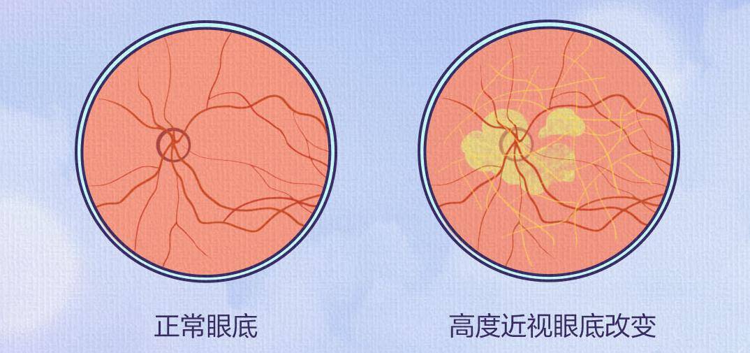 由于眼睛长期看近方,眼睛的调节过度,睫状肌紧张并前移,前房变浅变