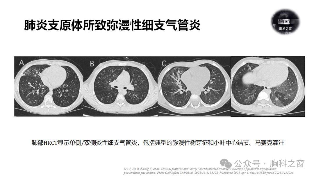 肺炎支原體肺炎再認識_呼吸道_細胞壁_心血管