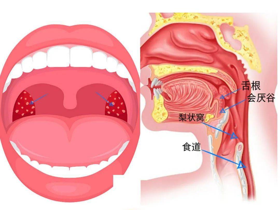 不容轻视的卡鱼刺