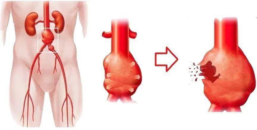 腹主动脉瘤的症状图片