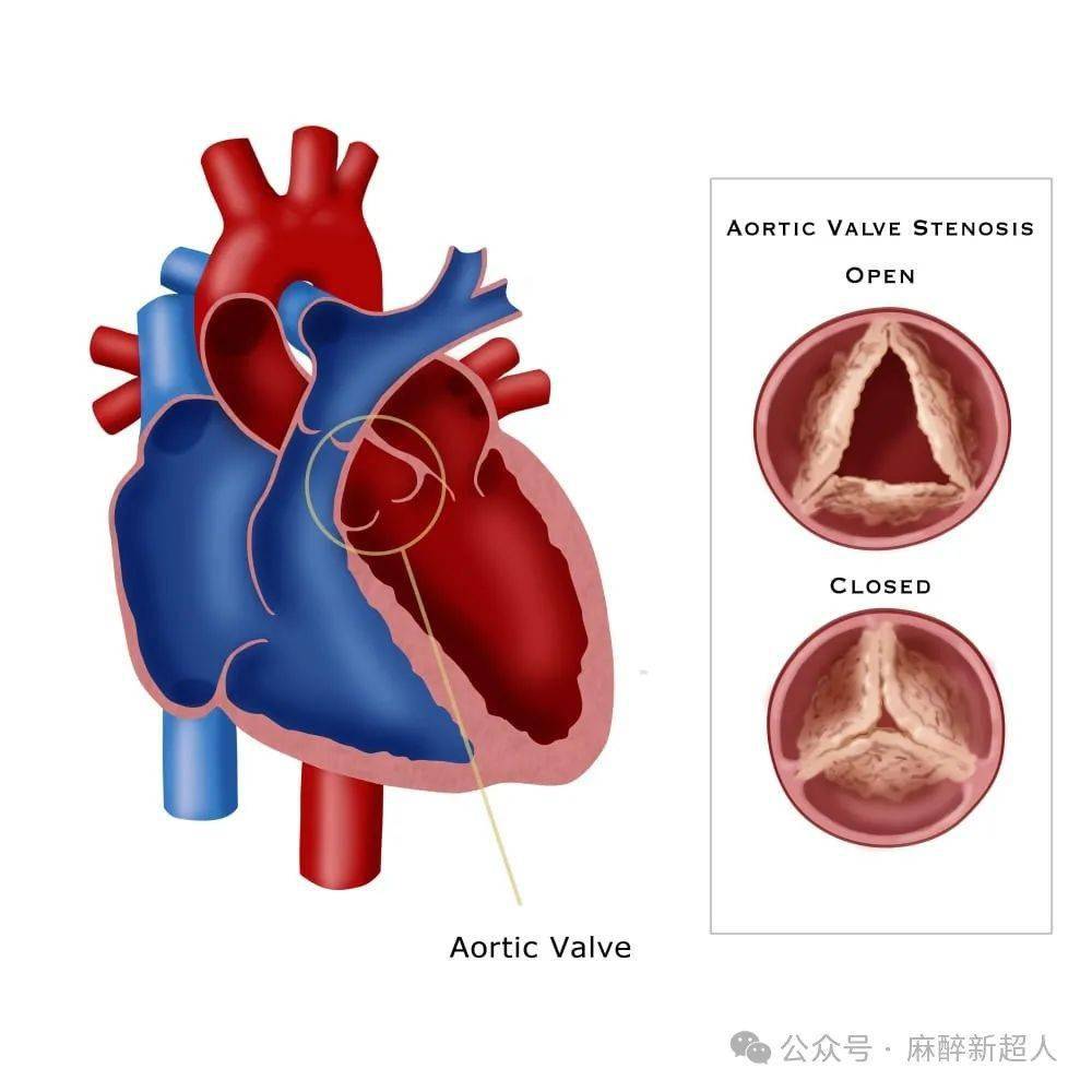 基礎知識丨主動脈瓣狹窄的麻醉管理要點_患者_血管