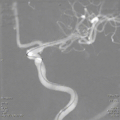 病例集锦第2期丨应用jasper弹簧圈系列治疗大脑中动脉