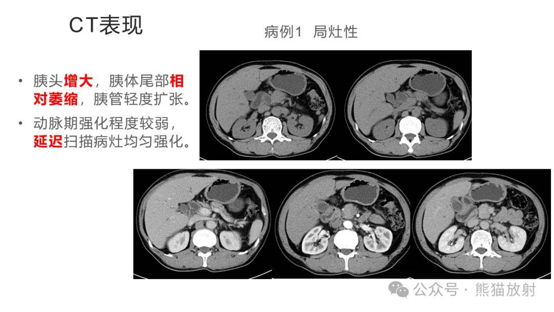 【省立影像读片】胰腺病变2402