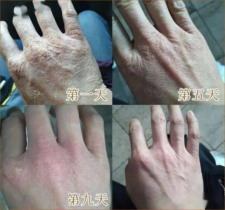 消灭患处病菌,真菌;沙棘果 牛油果油长效保湿 修复避免肌肤干燥皲裂!