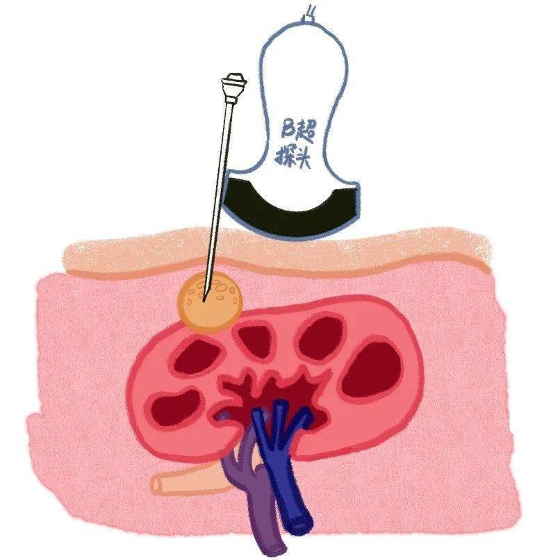 肾囊肿穿刺示意图龙华医院超声医学科龙华医院超声医学科成立于上世纪