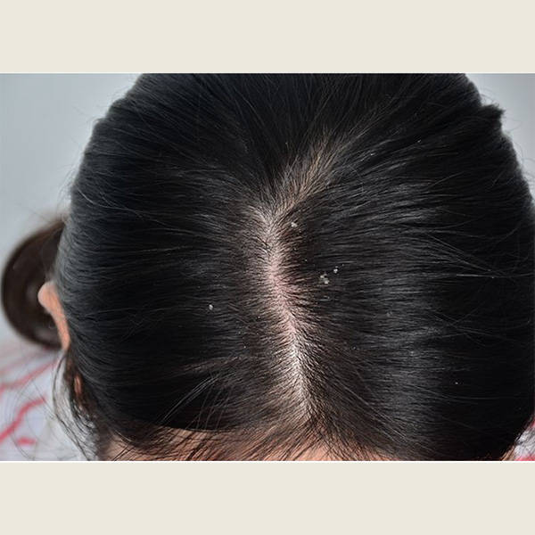 二硫化硒洗剂用前可以用洗发水吗?专业去屑洗发水推荐_头皮_问题_头发