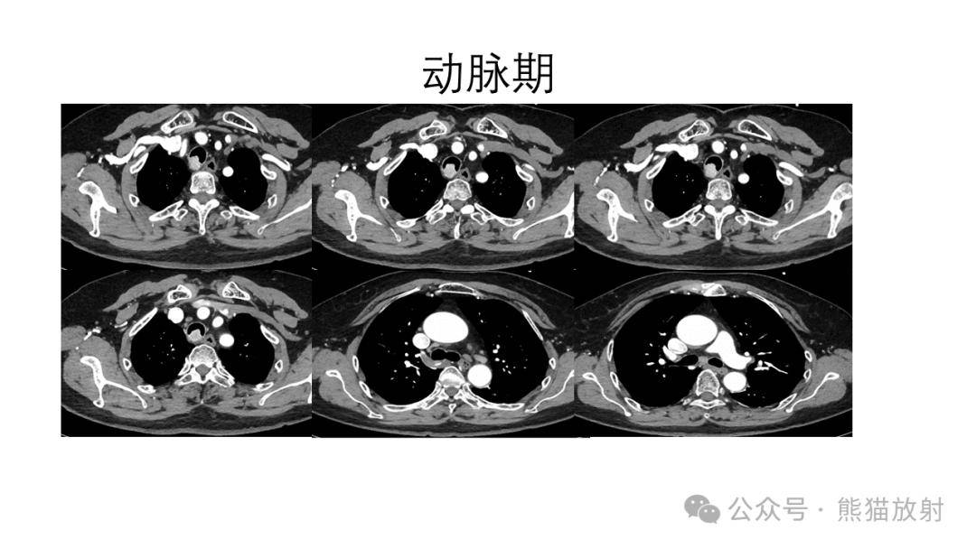 【省立影像读片】气管支气管肿瘤24.02_内容_检索_公众