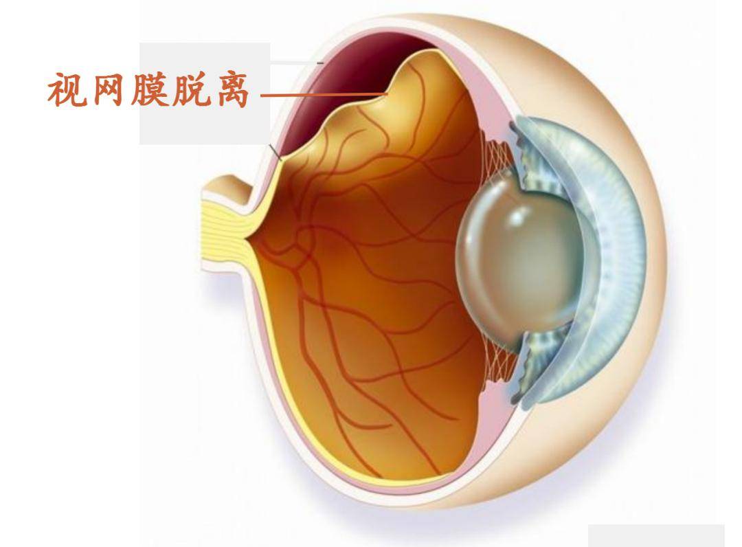 视网膜脱落外观图片