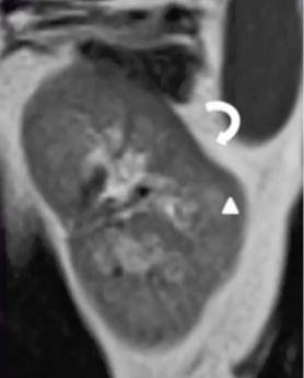 驼峰肾,马蹄肾,煎饼肾.肾脏结构异常 ct 图像,你都认识吗?
