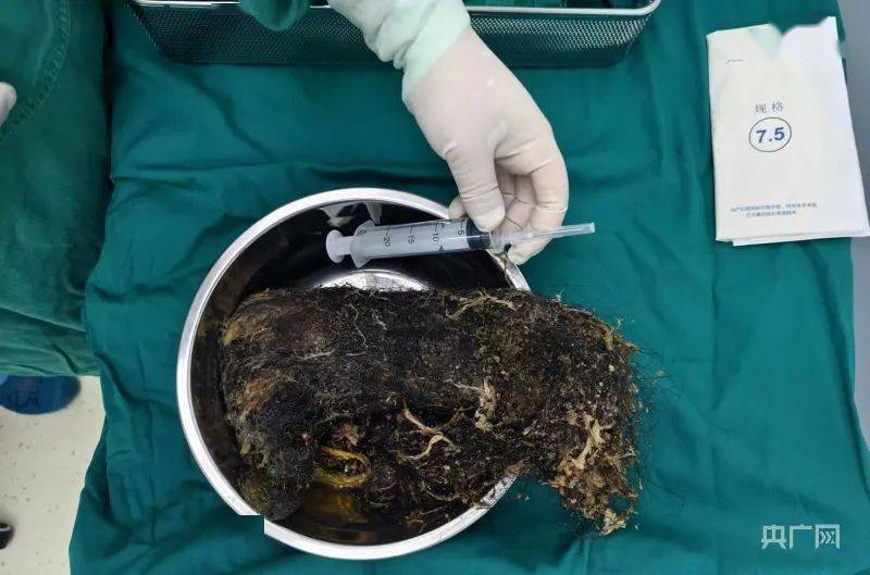 女孩胃里取出1.3公斤"毛石"_患者_手术_物质