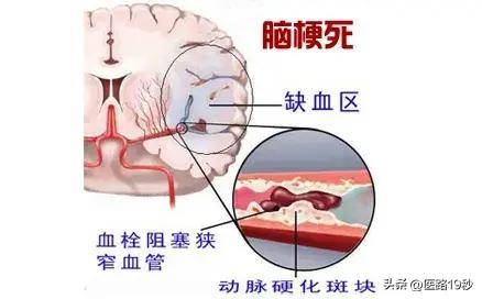 脑梗死症状图片图片