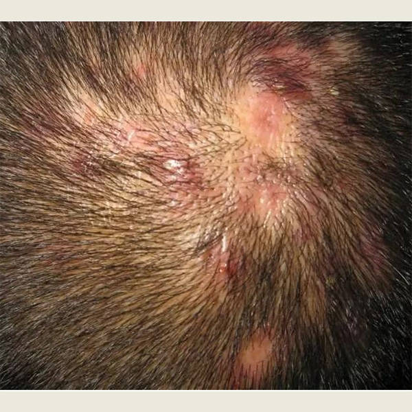 头皮屑小红疹等产生的原因:头皮屑是头皮上脱落的小片皮肤,通常由以下