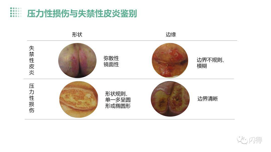 【ppt】失禁性皮炎患者的护理_直播_文库_闪得