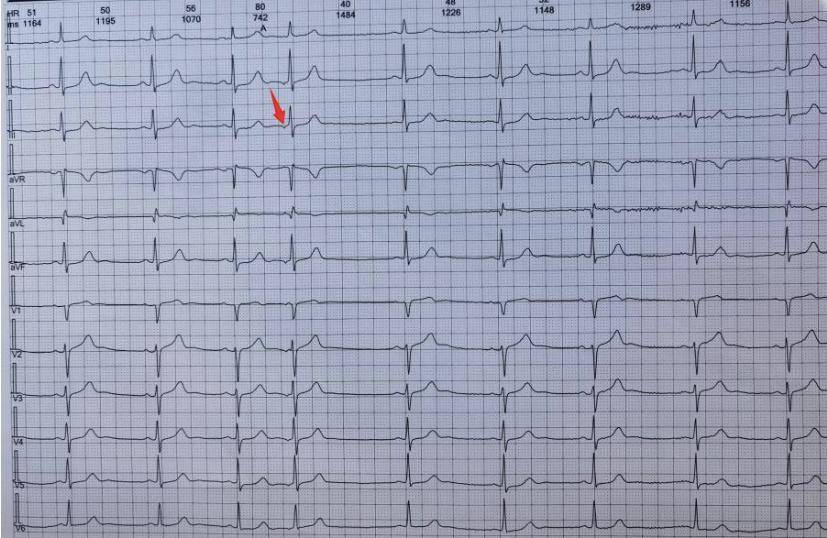 牢记10 个心电图诊断特征,快速鉴别心律失常!_心房_窦性_心室