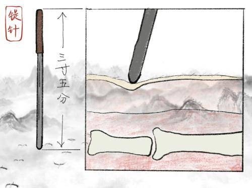 锋针取法于絮针,三隅环刃筩其身.体长约有一寸六,浅刺出血勿伤肉.