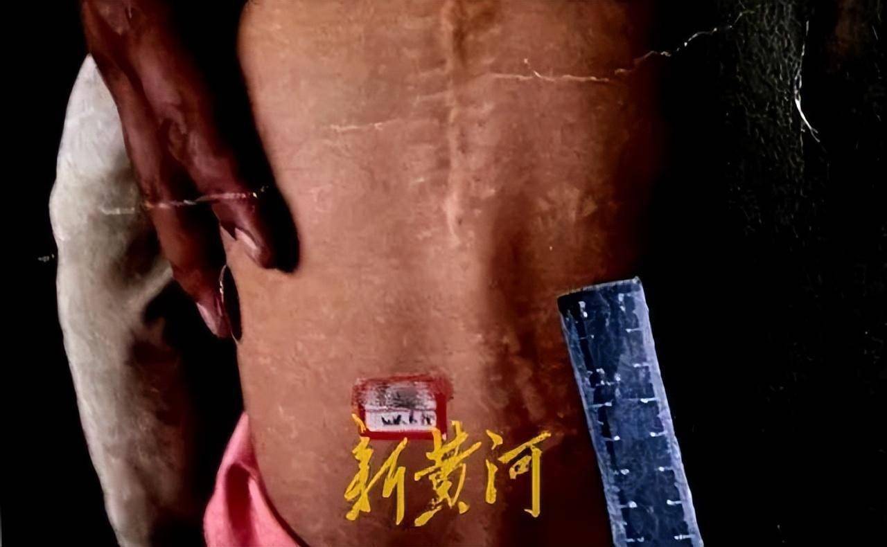 提醒着晓彤,她和别的同龄孩子不一样,自己体内剩余的二十多颗铁砂弹片