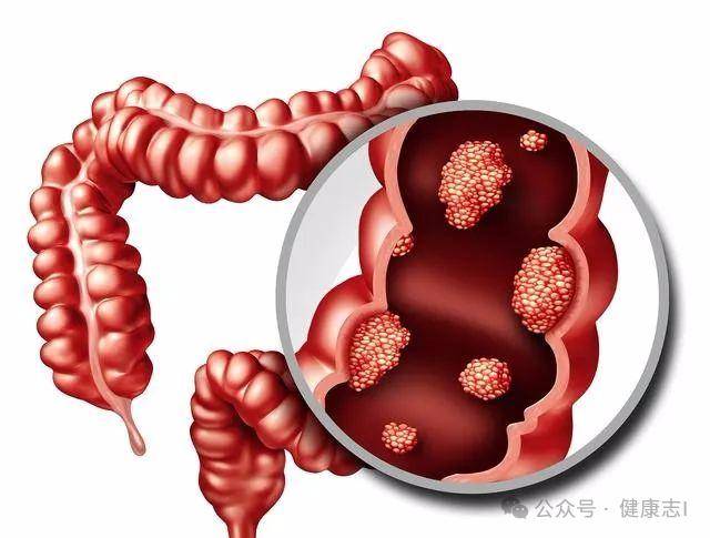 然而,值得注意的是,直肠癌大多数情况下是可以预防和治疗的,关键在于