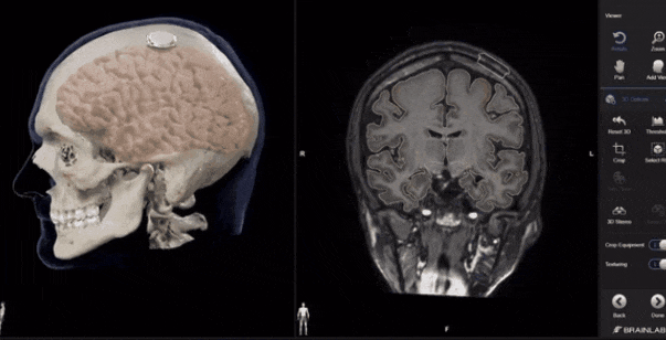 中国脑机接口有新突破,高位截瘫患者可以脑控光标?_控制_马斯克_团队