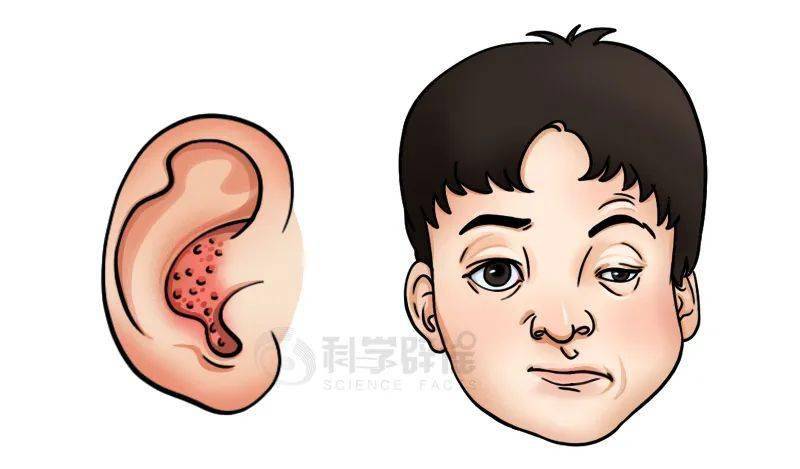 听神经时,可出现面瘫,耳痛及外耳道疱疹三联征,称为ramsay