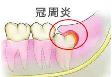 拔智齿的绝佳年龄,希望你不再错过!