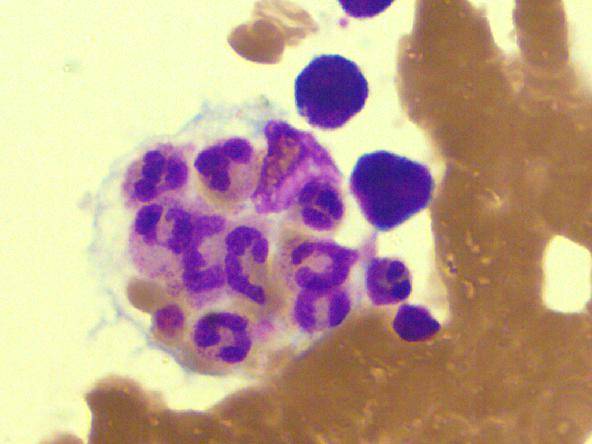 噬血细胞综合征 肺炎 高龄!