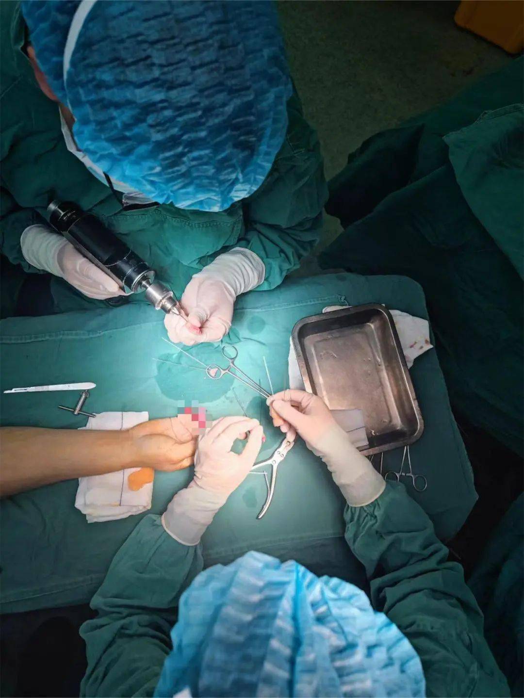 高质量发展丨区人民医院创伤科成功为贵州6岁幼童实施断指再植术