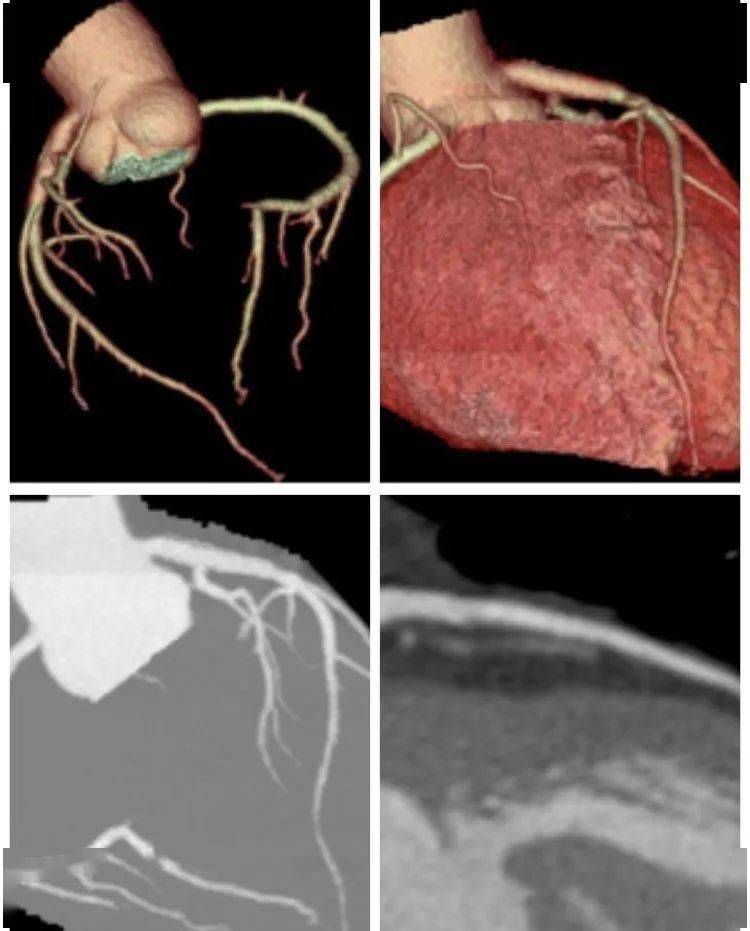 【技术展播】冠脉cta技术_检查_诊断_血管