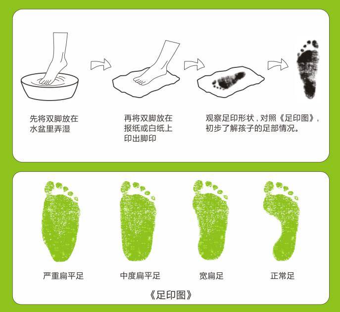 脚的中趾连线,属于正常足弓(图二);超过中趾连线,即可视为扁平足(图