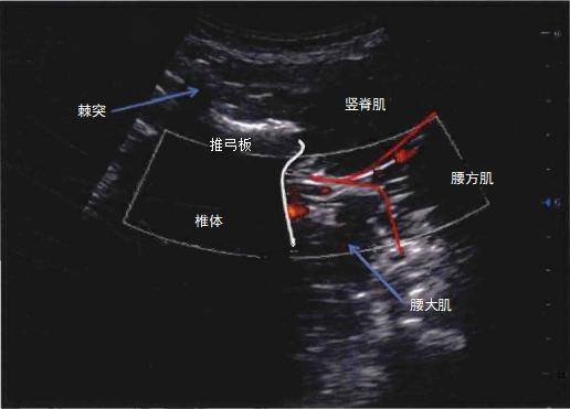 腰交感神经阻滞术图片