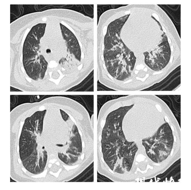 淮安一父亲感冒,亲了孩子一口,结果._反应_医生_月月