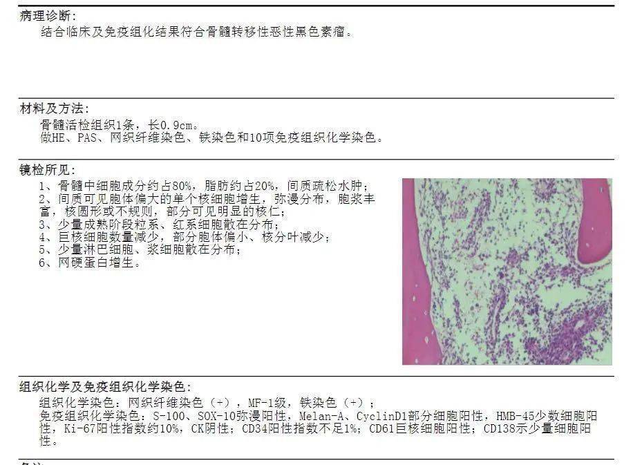 病例分享 骨髓转移性恶性黑色素瘤