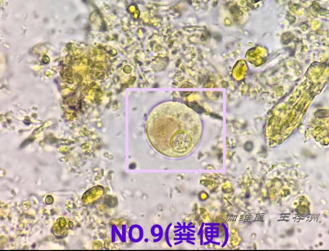 ▼「溶组织内/迪斯帕内阿米巴包囊」形态特征:溶组织内阿米巴包囊直径