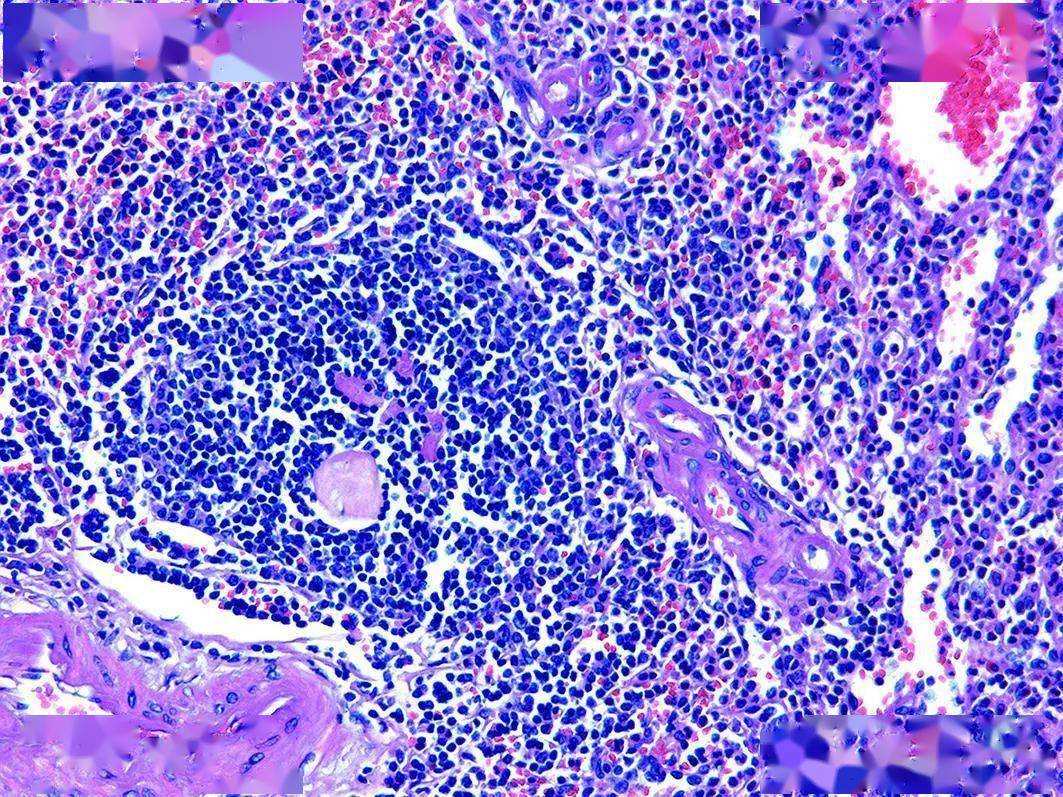 病例报告|胰腺内副脾误诊2例_患者_肿瘤_尾部