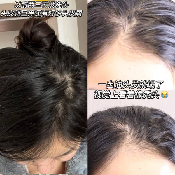 适合油性头皮的去屑洗发水有哪些?_头发_问题_效果