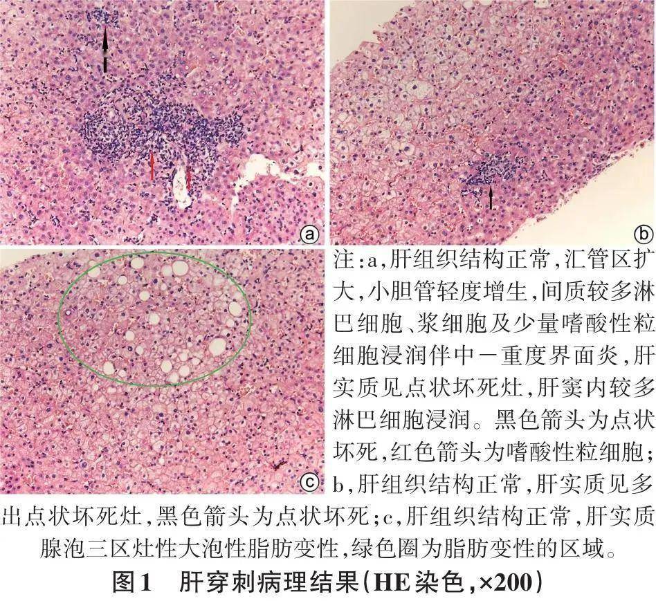 罕见病例|hiv感染合并自身免疫性肝炎-原发性胆汁性
