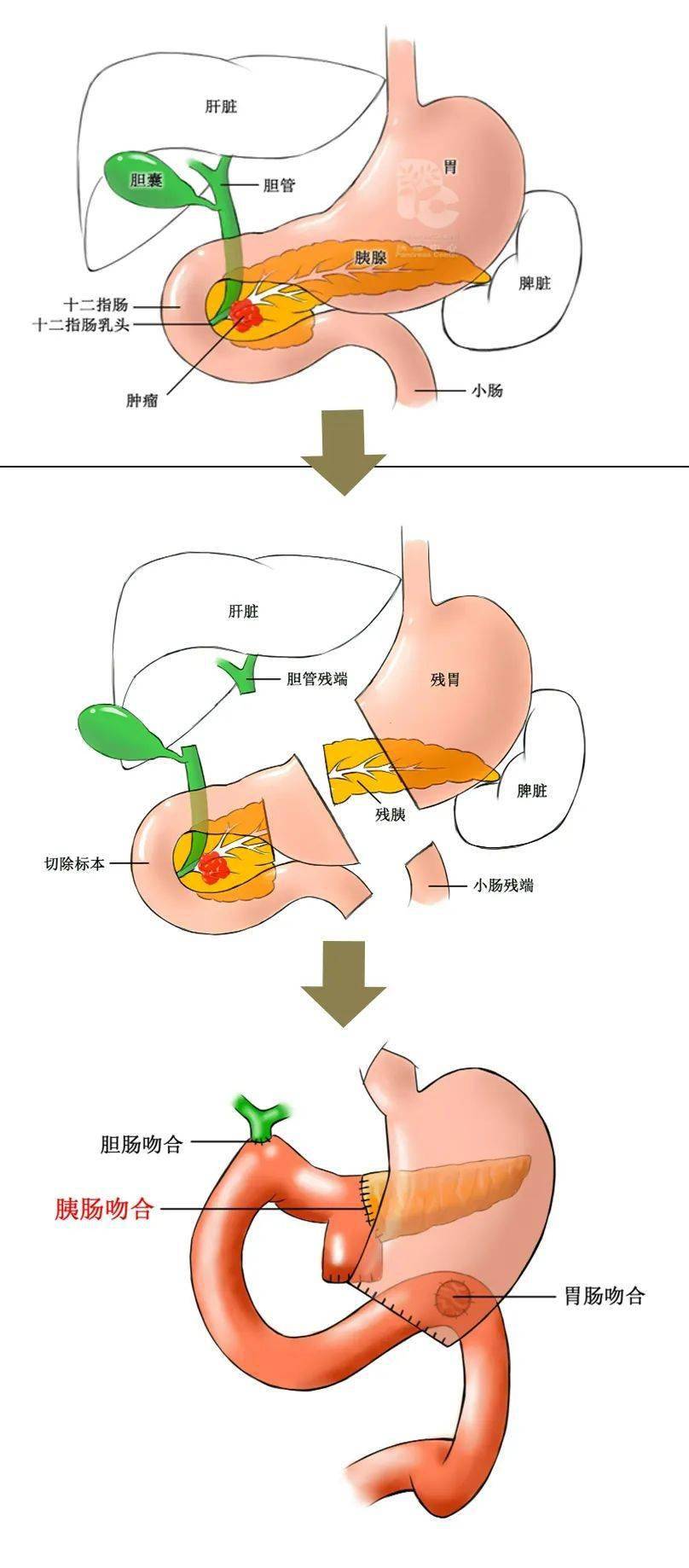 普外科完美攀登普外科手术的珠穆朗玛峰3d腹腔镜下胰十二指肠切除手术