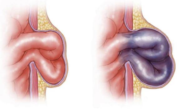 疝气不善,不可忽视