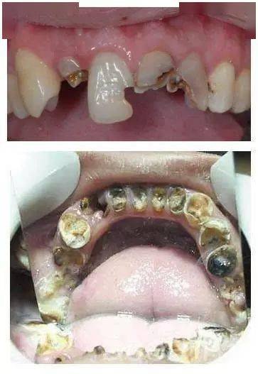 牙齿腐蚀初期怎么处理图片