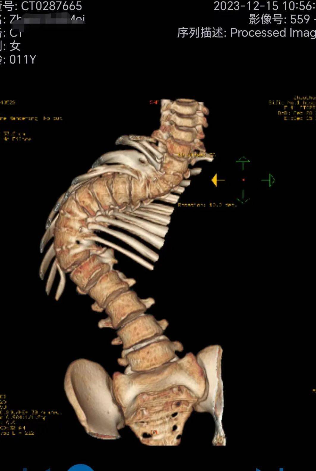 牵引前脊柱全长ct三维重建图片2023年12月29日张骏院长带领脊柱脊髓