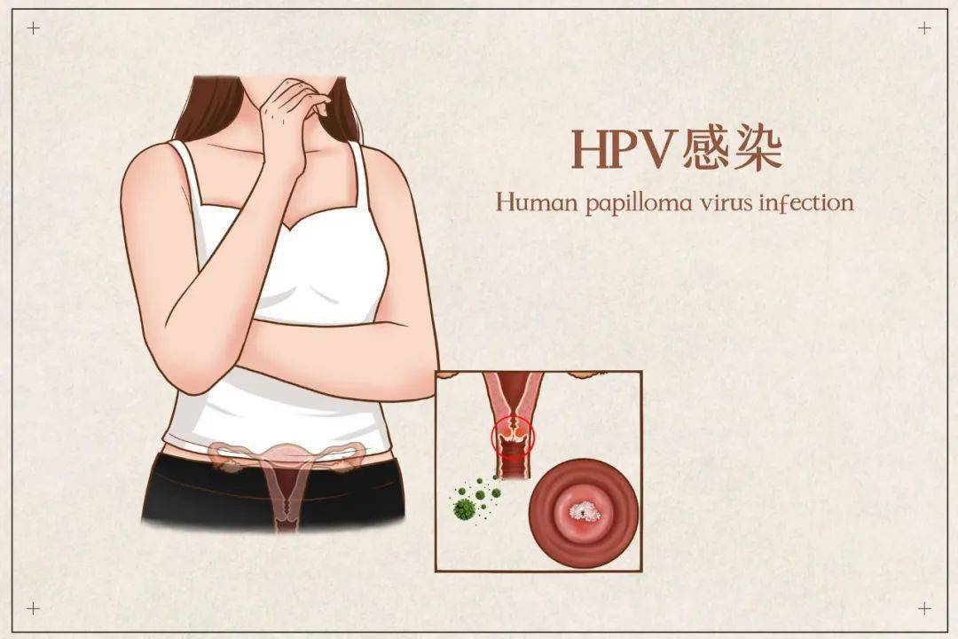 感染了hpv不一定会得宫颈癌,但100%的子宫颈癌,88%的肛门癌等肿瘤与