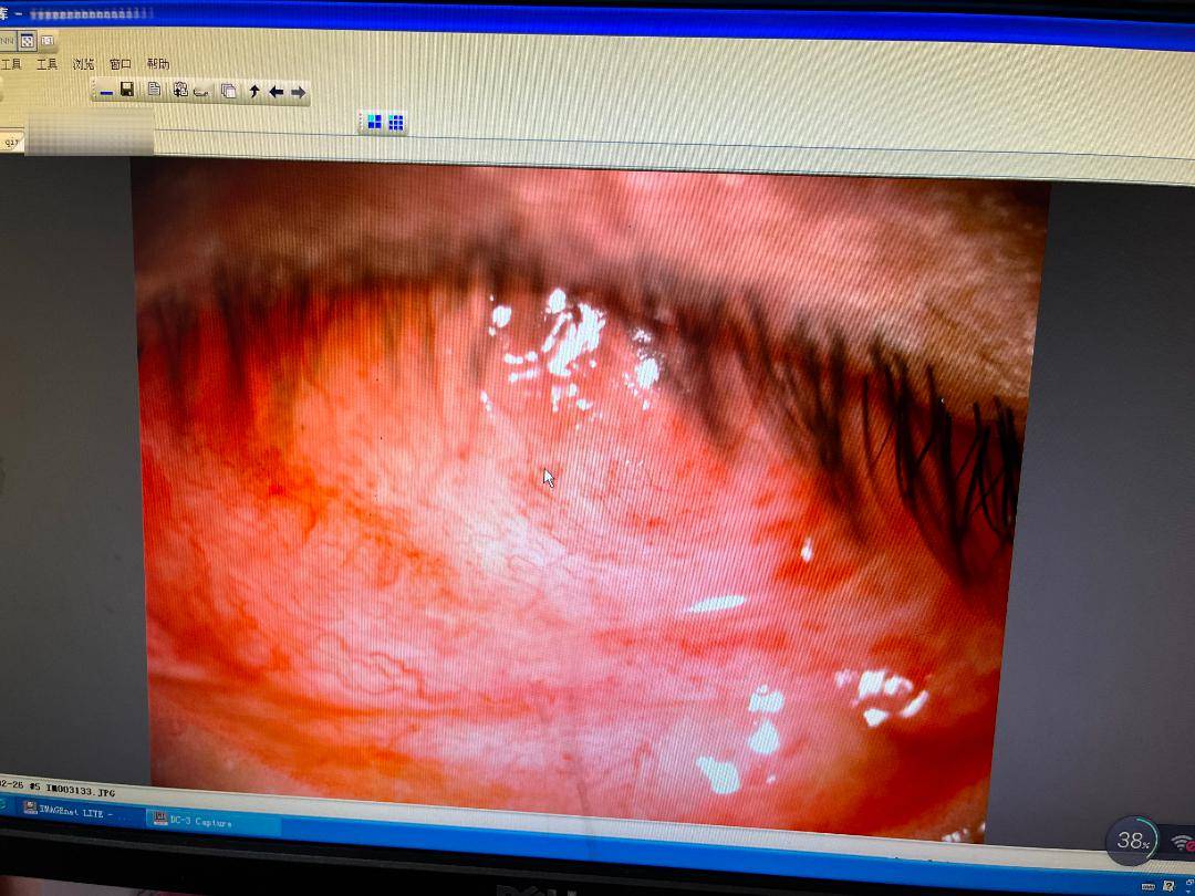 一层薄薄羊膜修复碱烧伤角膜州人民医院眼科成功开展首例无缝线羊膜