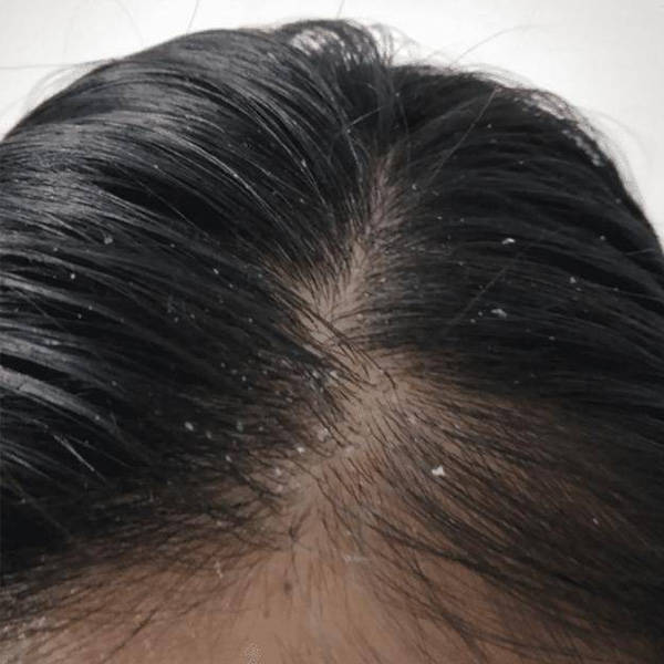 头发又痒又有头皮屑用什么洗发水好