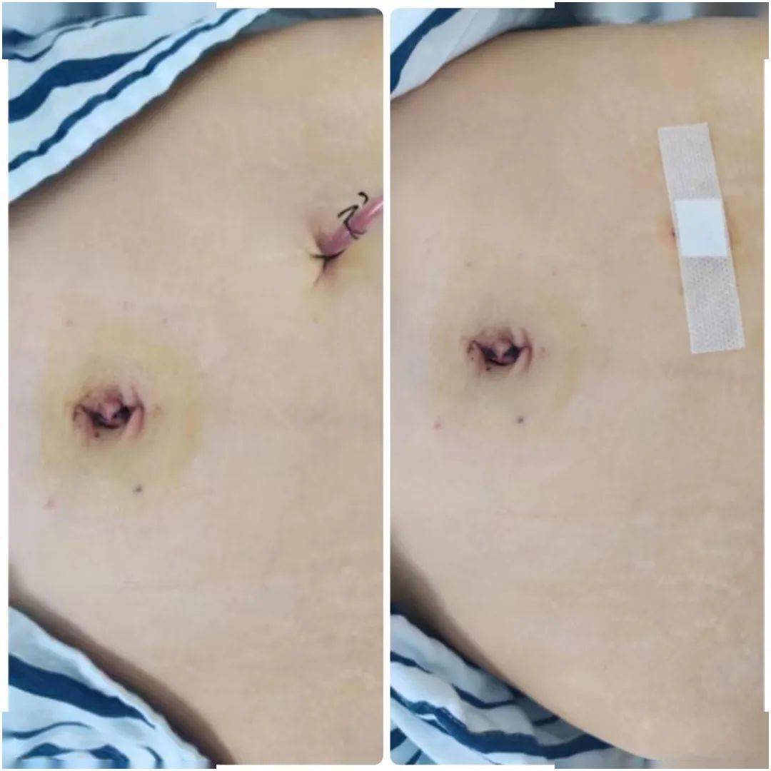 我院妇科在嘉定院区开展首例单孔腹腔镜手术