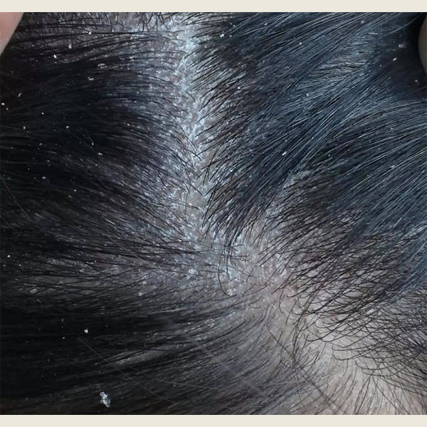 头皮有小疙瘩用什么洗发水