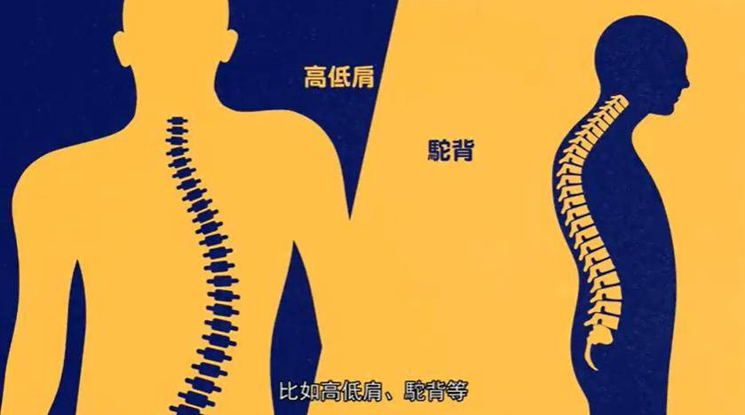 这个病很多孩子都耽误了,女孩更高发_脊柱_坐姿_严重