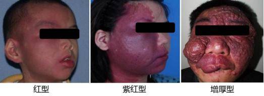 身上出现这种红斑或红色肿块就要警惕了因为很有可能是