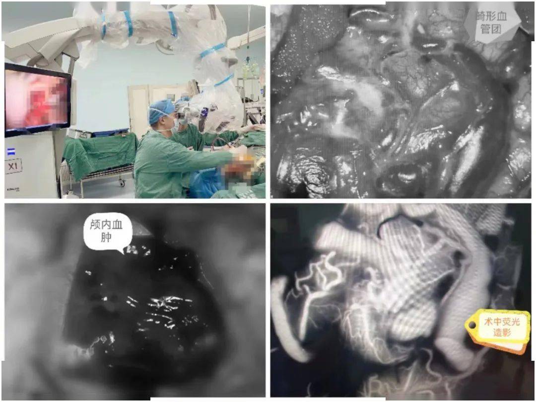 聚焦临床罕见脑血管病致脑出血昏迷市中心人民医院神