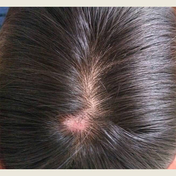 头皮出油有头皮屑用什么洗发水