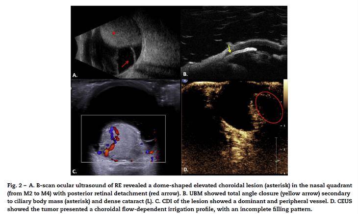 世界青光眼周丨深入探索青光眼患者的世界病例荟萃揭示诊疗之路一